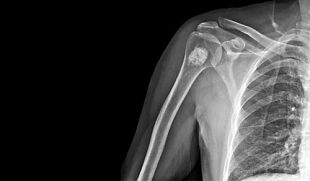 Bone tumor near shoulder seen during X-ray