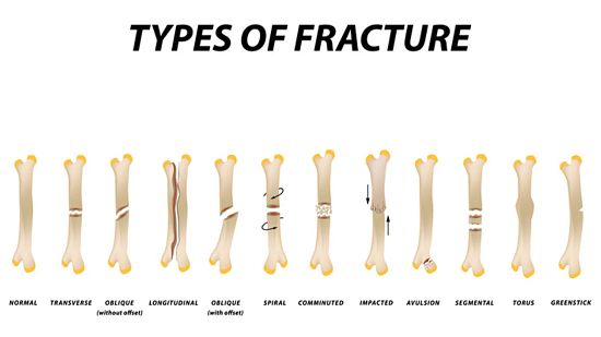 Image depicting different degrees of bone fractures.