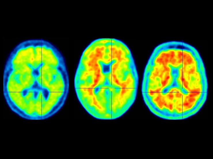 Lecanemab and donanemab, antibody treatments administered intravenously, are new therapies clinically proven to slow the rate of cognitive decline.