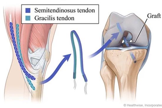 Diagram of ACL reconstruction surgery