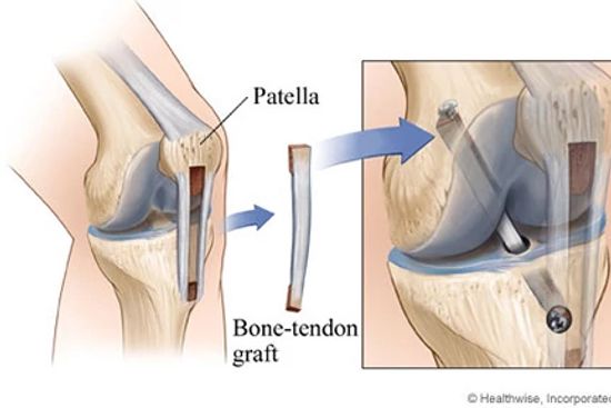 Diagram of ACL reconstruction surgery