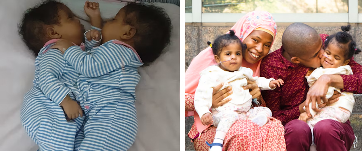 Inside the Successful Separation Surgery of Conjoined Twins: “We Are So Grateful!”