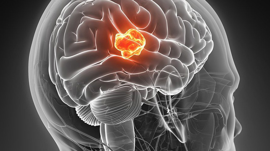 Understanding Glioblastoma