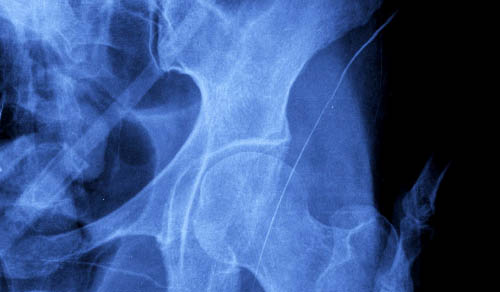 Innovations in Review: Orthopedics