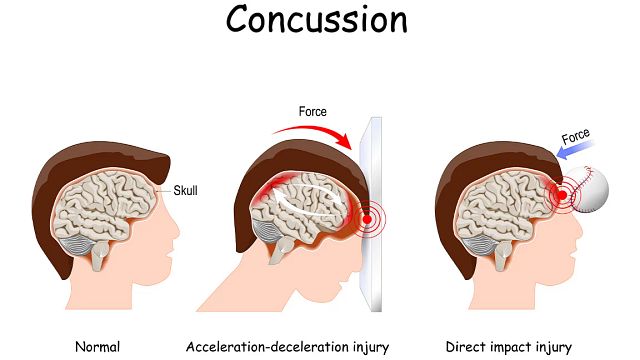 Diagram of skull sustaining trauma from force to the head.