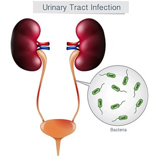 Diagram of bacteria in the ureters leading to a urinary tract infection