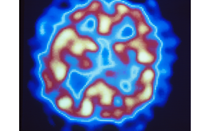 PET scan of the brain of a patient with schizophrenia having a hallucination.
