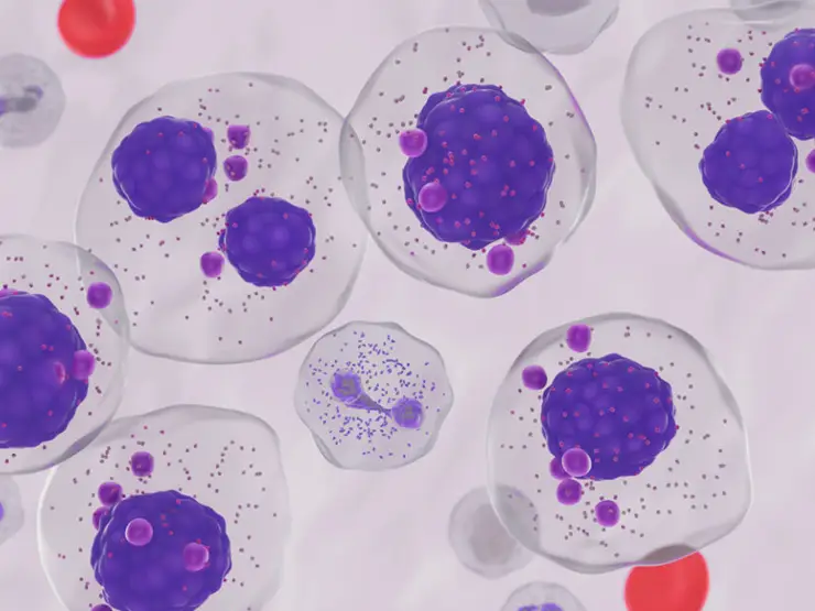 image of Multiple Myeloma