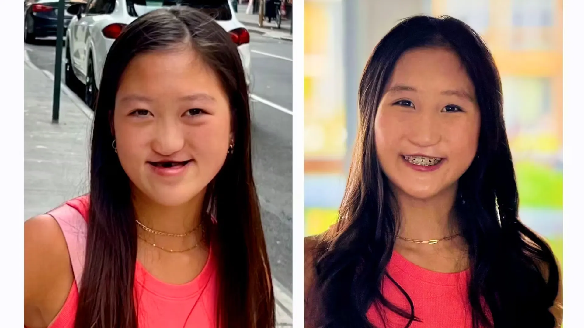 Before and after reconstructive surgery photos of Jade Metivier