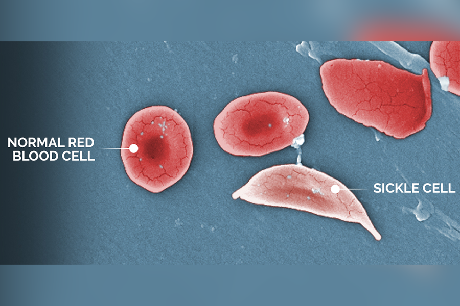 What to Know About Sickle Cell Disease